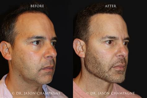 Custom Chin And Jaw Implants Gallery Beverly Hills Plastic Surgeon Dr Jason Champagne