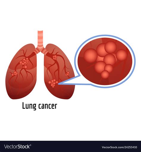 Lung Cancer Icon Cartoon Style Royalty Free Vector Image