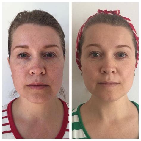 Before After Pictures Face Yoga For You