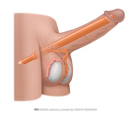 Penile Implants Patient Information