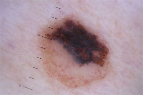 How To Identify And Prevent Melanoma Dy Dermatology