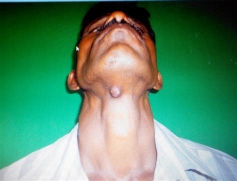 Dermoid Cyst Of Submental Region A Case Report Journal Of Case