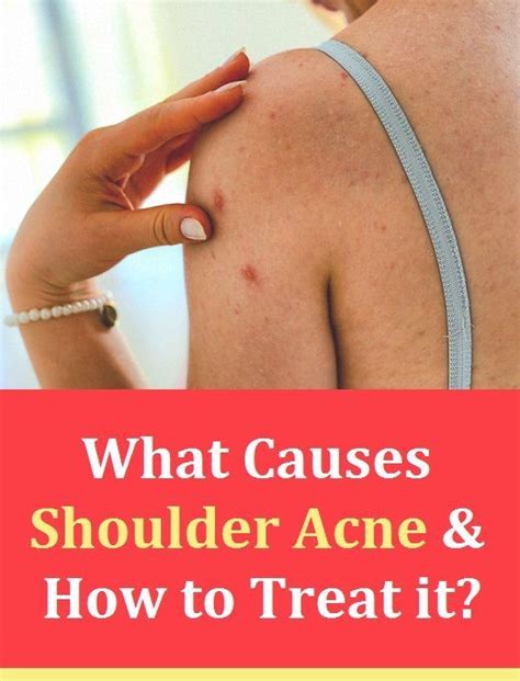 What Causes Shoulder Acne And How To Treat It Shoulder Acne Acne
