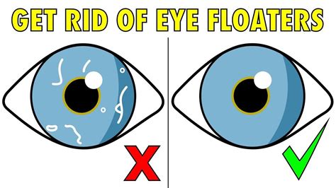 The 2 Step Solution To Naturally Get Rid Of Eye Floaters Youtube