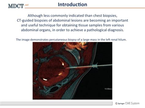 Ct Guided Biopsy Of The Abdomen