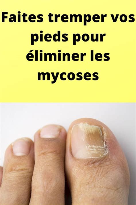 Faites tremper vos pieds pour éliminer les mycoses en 2021 Ongles en