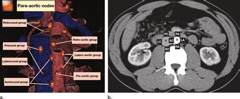Para Aortic Lymph Node Group Illustration A And Axial Contrast