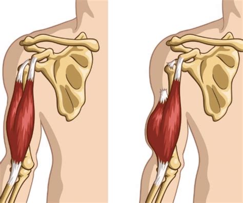 Biceps Tendon Tear A Common Elbow Injury Orthopedic Center For Sports