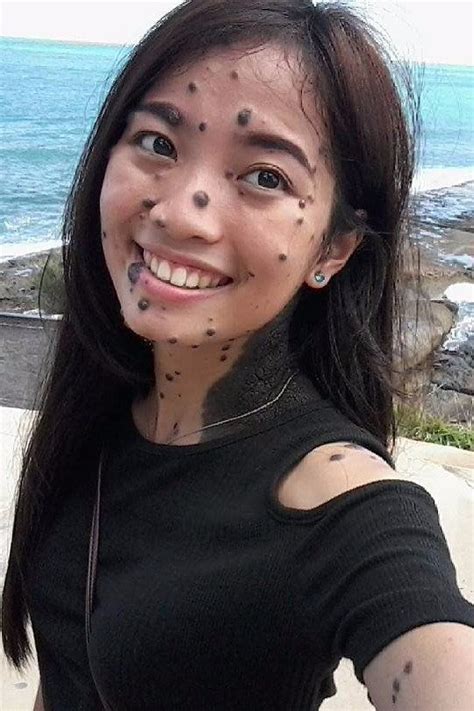 How Woman Learned To Embrace Her Body Covered In Moles Beatiful