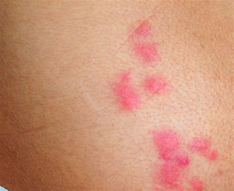 What Bed Bug Bites Look Like Pictures My Xxx Hot Girl