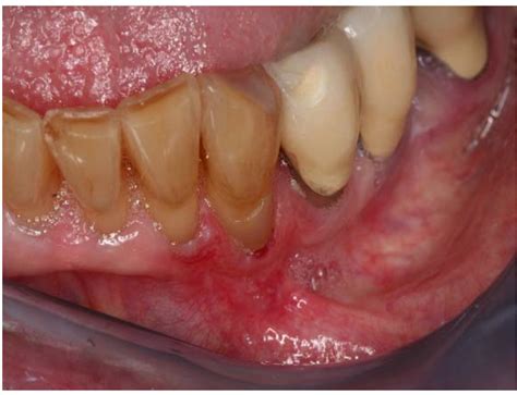 🎉 Erythroplakia Oral Erythroplakia 2019 01 09