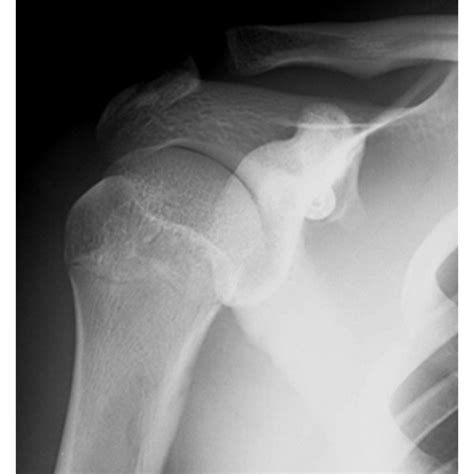 Plain Radiographs Showing Epiphyseal Fracture At The Origin Of The