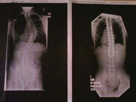 Before And After Pics Of My Posterior Spinal Fusion Scoliosis Treatment