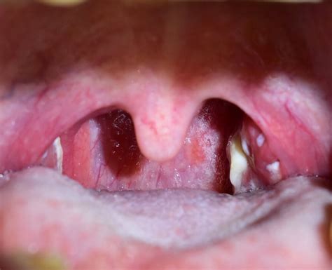 Normal Healthy Tonsils