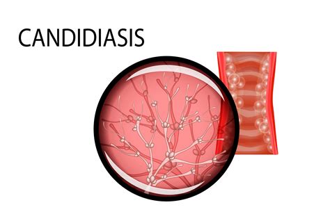 What Is A Candidiasis Offers Online Save 69 Jlcatjgobmx