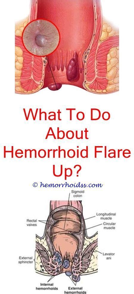 when you need surgery for hemorrhoids how do they remove a hemorrhoid how to remove hemorrhoid