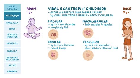 Viral Exanthems Of Childhood Pathology Review Video Osmosis