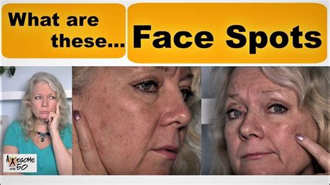 Getting Spots On Face Looked At By Dermatologist Mature Women Over 50