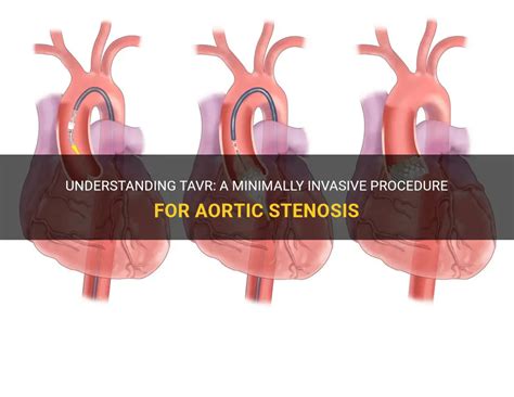 Understanding Tavr A Minimally Invasive Procedure For Aortic Stenosis