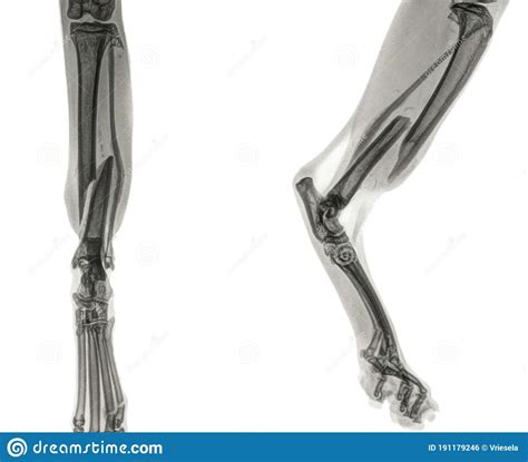 X Ray Of The Hind Leg Of A Cat With A Fracture Of The Shinbone Tibia