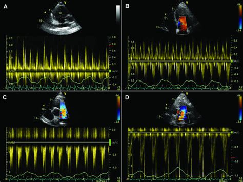 Physiological Variations Of The Velocity Across The Tricuspid Valve