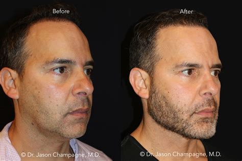 Get That Perfect Celebrity Jawline — Plastic Surgeon Beverly Hills Ca