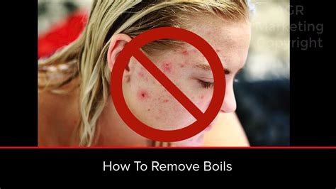 How To Remove Boils From Body Youtube