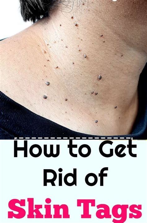 How To Remove A Skin Tag Off A Dog Howotremvo