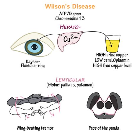 Neuroanatomy Glossary Wilsons Disease Draw It To Know It