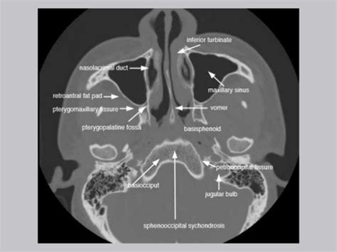 Cross Sectional Anatomy Of Paranasal Sinus Human Body Paranasal
