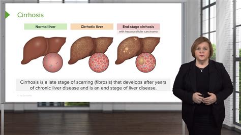 Liver Cirrhosis Med Surg Nursing Lecturio