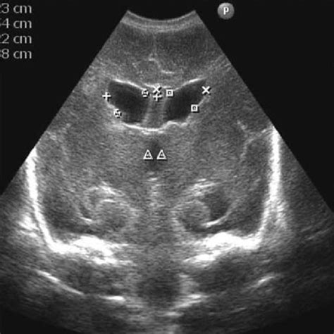 Cranial Ultrasound Scan Sagittal View Showing Considerable Dilatation