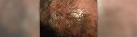 Scalp Ringworm Pictures