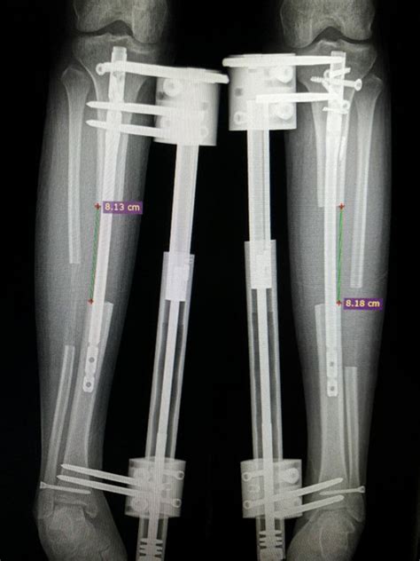 Leg Shortening Surgery Turkey