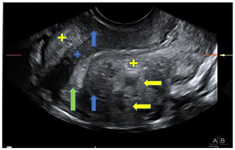 Jcm Free Full Text Sonographic Signs Of Adenomyosis In Women With