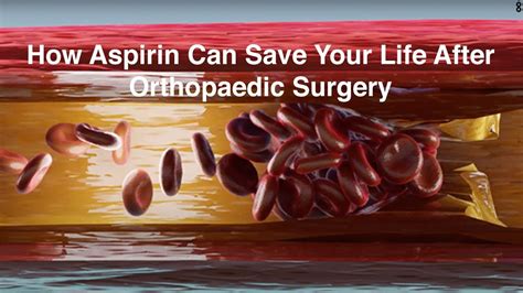 Aspirin Can Prevent Life Threatening Blood Clots After Orthopedic