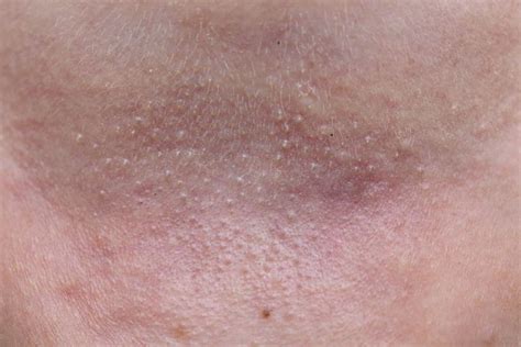10 Types Of Skin Bumps Facty Health