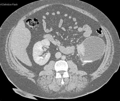 Bosniak 2 Cyst Left Kidney Kidney Case Studies Ctisus Ct Scanning