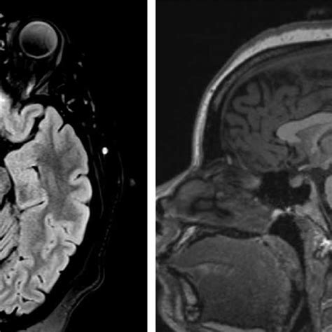 Brain Mri Of The Described Case The Images Show Axial Flair On The