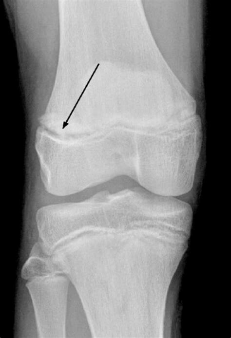 Distal Femoral Physeal Fractures Dont Forget The Bubbles