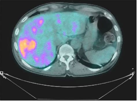 A Case Of Metastatic Adenocarcinoma On A Background Of Penoscrotal