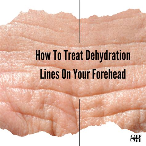 How To Treat Dehydration Lines On Forehead Skin Harmonics