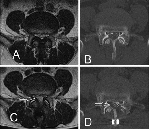 Case A Preoperative Axial Magnetic Resonance Mr Image A And A