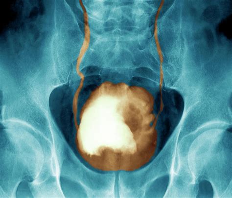 Bladder Cancer Photograph By Zephyrscience Photo Library Pixels
