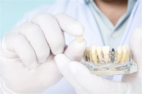 How Long Do Dental Implants Last A Complete Guide Stabili Teeth