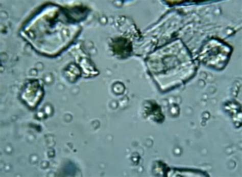 For this, you will be asked to provide a urine. Uric acid crystals in Urine - causes, treatment, images