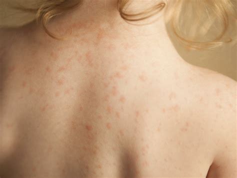 Skin Rashes In Children
