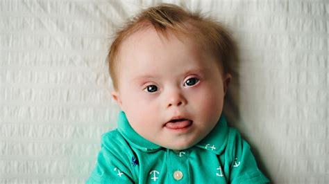 Four In Five Children With Down Syndrome Are Born To Mothers Under The