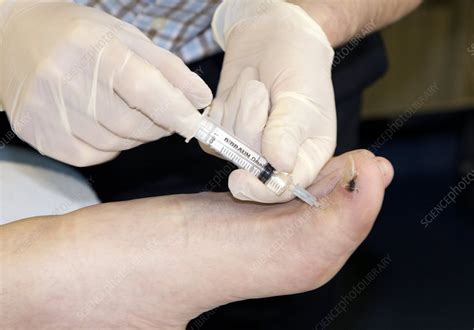 Local Anaesthetic Injected Into Toe Stock Image C0028770 Science