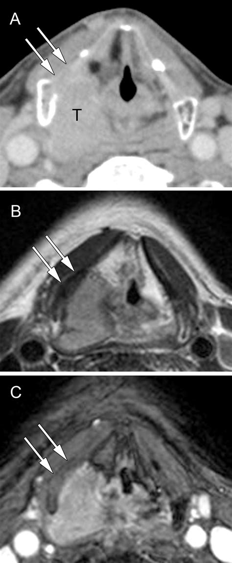 Primary Staging Of Laryngeal And Hypopharyngeal Cancer Ct Mr Imaging